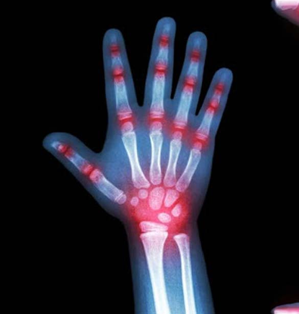 Arthritis of the Hand Treatment Top Orthopedic Specialists in Forest