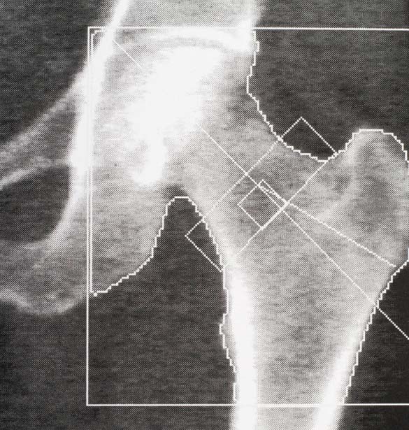 bone density test results