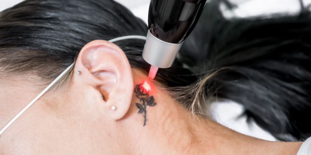Tattoo Removal in Queens, Queens Medical Center Guide