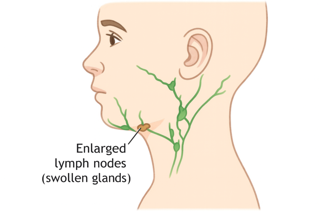 An anatomical illustration showing a side view of a child’s head and neck with the lymphatic system highlighted in green. Several lymph nodes are visible under the jaw and along the neck, with one labeled “Enlarged lymph nodes (swollen glands)” to indicate inflammation or infection.