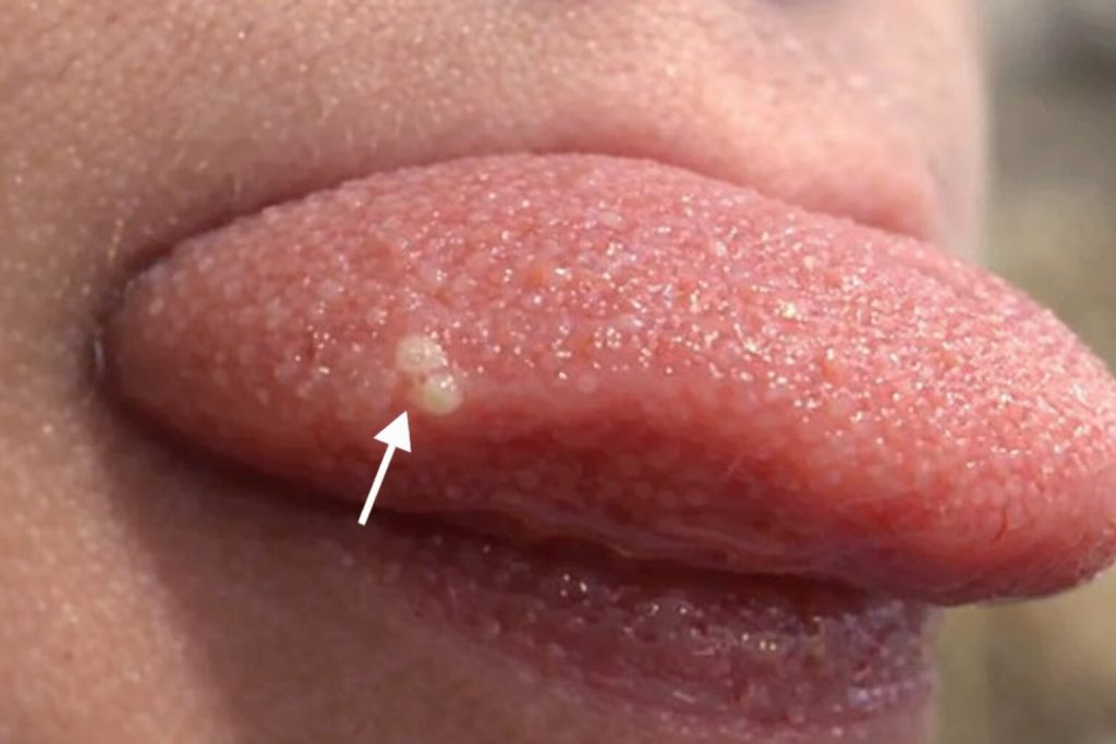 Protuberancias de clamidia en la lengua: Causas, síntomas y tratamiento