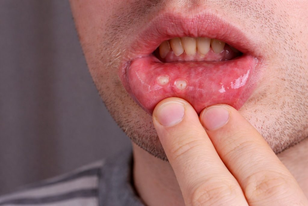 ¿Qué aspecto tienen los bultos de clamidia en la lengua?