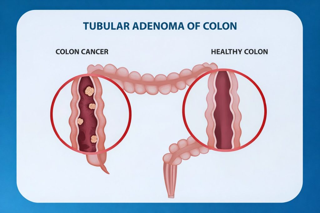colon cancer vs healthy colon